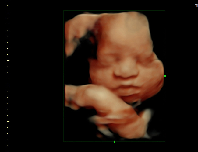 3D ultrasound image at 29 weeks